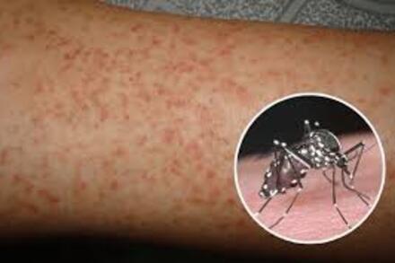 Hà Nội: Giảm số ca, thu hẹp địa bàn mắc sốt xuất huyết