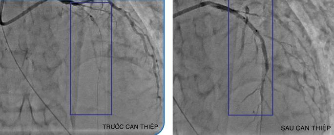 Cứu bệnh nhân Campuchia nhồi máu cơ tim từ cửa tử - Ảnh 2.